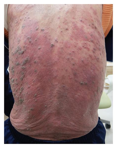 A Multiple Flat Black Spots On The Patients Back Three Months Prior