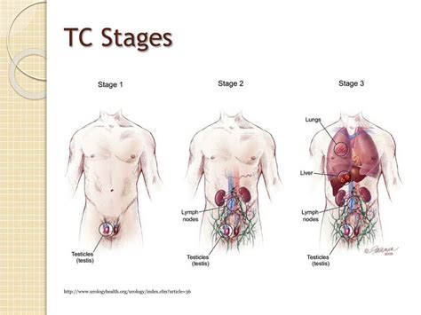 What Are The Stages Of Testicular Cancer Urology Care Foundation My Xxx Hot Girl