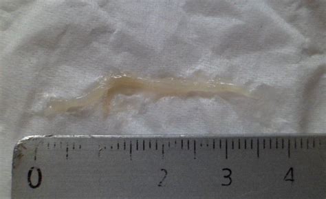 A Photo Of A Small Roundworm Found In The Phlegm At Parasites Support Forum Alt Med With
