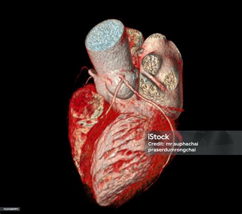 Ct Cardiac 3d Or Cta Coronary Artery Stock Photo Download Image Now