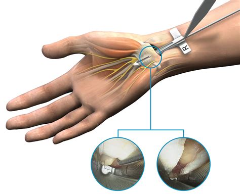 The anatomy of the carpal tunnel. Endoscopic Carpal Tunnel Release (ECTR) | Trice Medical