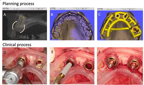 Clinical Procedure Of Guided Surgery A And B Optimal Implant Position Download Scientific