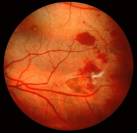 Maybe you would like to learn more about one of these? Peripheral Tear - Retina Image Bank