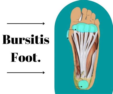 Bursitis Foot Treatment In Pune Archives The Prolotherapy Clinic