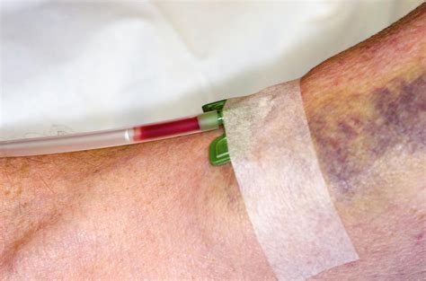 Haemodialysis Cannula In Arm Photograph By Dr P Marazziscience Photo