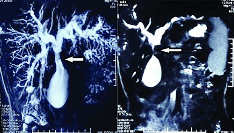 Mrcp Images Showing Intraluminal Filling Defect At Chd Cbd Cystic Duct