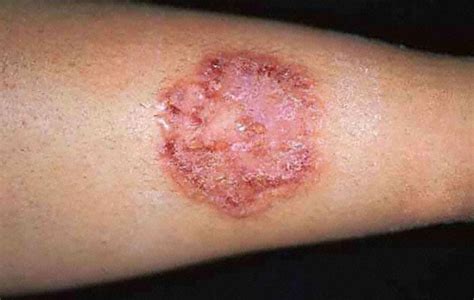 Ringworm Body Symptoms Causes Treatment And Diagnosis Findatopdoc