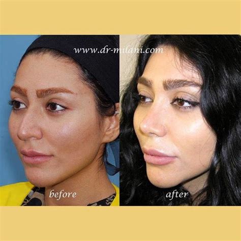 Iranian Nose Plastic Surgery Before And After 1 Rhinoplasty Cost