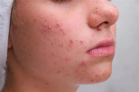 Everything You Should Know About Acne Nashé Beauty