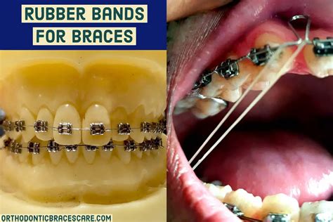 What Do Rubber Bands Do For Braces Uses Types Colors Orthodontic