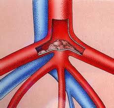 The largest artery in the body that is the main highway for the propagation of oxygenated blood from the heart to the tissues is the aorta. Saddle Thrombus In Cats | Veterinary Advice, Animal News ...