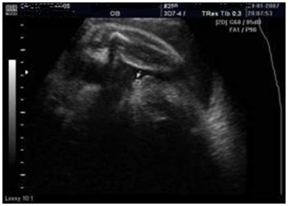 FULL TEXT Early Detection Of Fetal Micropenis After IVF ICSI