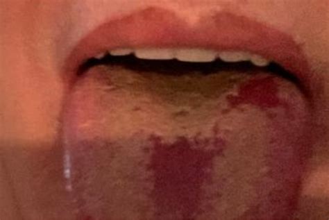 Seeing increasing numbers of covid tongues and strange mouth ulcers. Changes in the tongue begin to appear as new symptoms of Covid-19 - World Today News