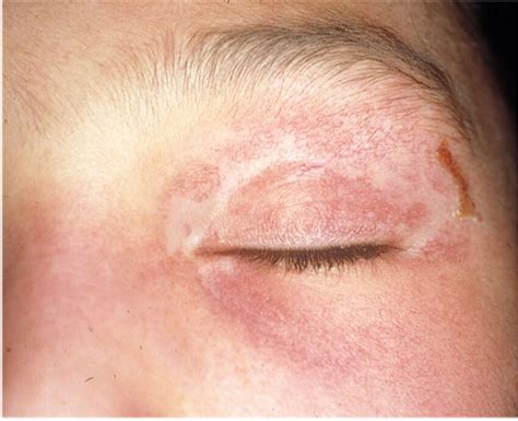 Appearance Of The Heliotrope Rash Coinciding With The Onset Of