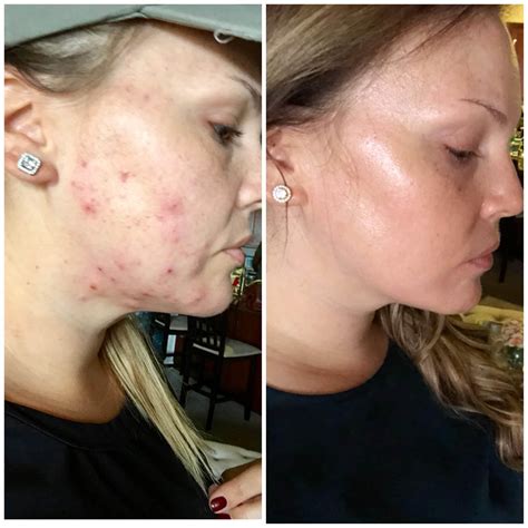 Accutane For Adult Acne My Experience