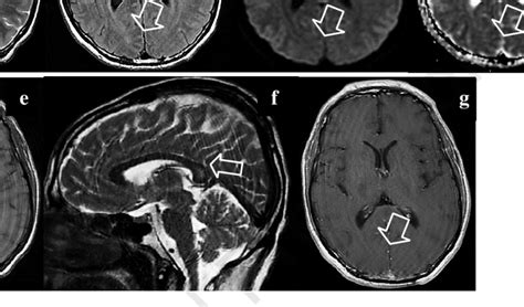 Brain Mr Images Showing An Oval Lesion In The Splenium Of The Corpus