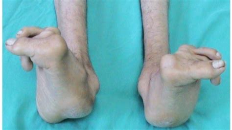 What Is Marfan Syndrome Symptoms Causes Niams