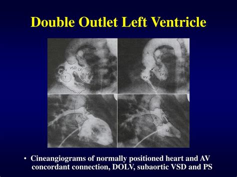 Ppt Double Outlet Right Ventricle Powerpoint Presentation Free