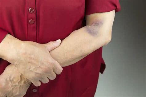 How Does Leukemia Bruising Differ From A Normal Bruise Page 3 Of 8