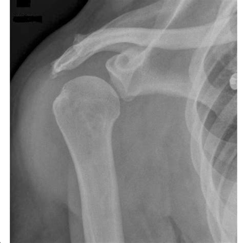 Pre Operative Ap Right Shoulder Xray Without Degenerative Signs