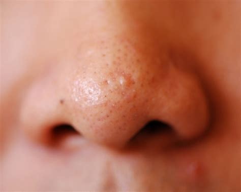 Ways To Get Rid Of Blackheads How To Remove Blackheads Tips For Getting Rid Of Blackheads