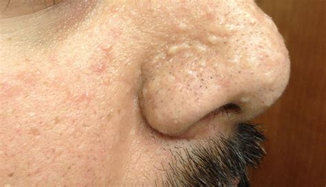 Derm Dx Small Papules On The Nose And Cheek Clinical Advisor
