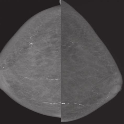 Retroareolar Cysts In Ultrasonography Of The Breast Download