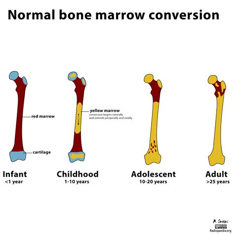 Red marrow in adults, red marrow is confined mostly to skeletal system bones of the skull, pelvis, spine, ribs, sternum, shoulder blades, and near the point of attachment of the long bones of the arms and legs. Diagram - normal marrow conversion | Image | Radiopaedia.org