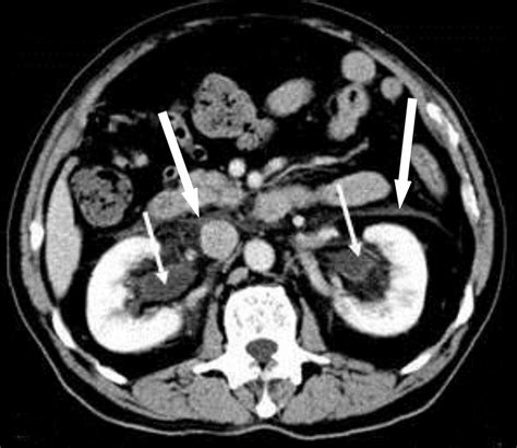 E In The Renal Medulla Spontaneous Urinary Extravasation Large White