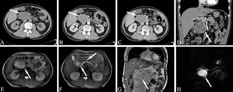 Frontiers Cystic Neoplasms Of The Pancreas Differential Diagnosis