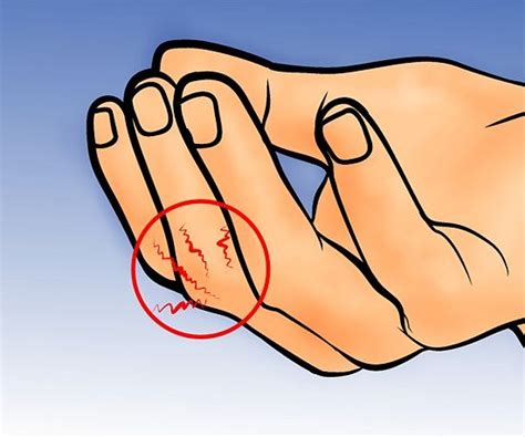 how to treat a broken finger emergency medical medical knowledge first aid