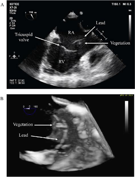 Vegetations On Pacemaker Lead Transthoracic Echocardiography