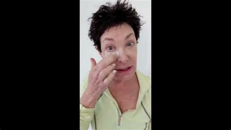 Day 10 Post Tca Peel And Sculptra Youtube