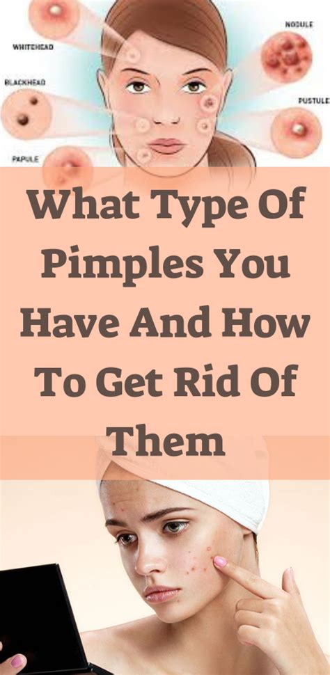 what type of pimples you have and how to get rid of them natural remedies green pimples on
