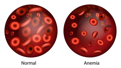 ¿qué Es La Anemia Síntomas Causas Y Cómo Tratar La Enfermedad