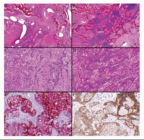 Metaplastic Carcinoma Of The Breast With Dominant Squamous And