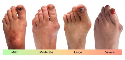 Bunions Diagnosis Cause And Treatment London Foot And Ankle Surgery