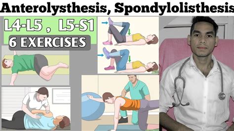 Anterolisthesis Spondylolisthesis L4 L5 S1 Exercise Treatment Low Back