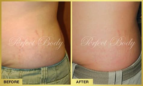 Stretch Mark Reduction Gallery Perfect Body Laser And Aesthetics