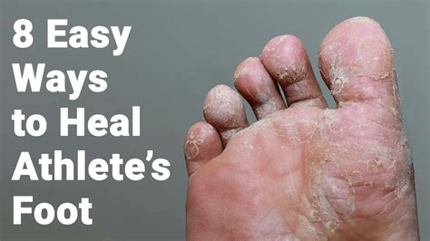 8 Easy Ways To Heal Athletes Foot