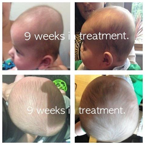 Albums 101 Wallpaper Pictures Of Flat Head Syndrome In Babies Latest
