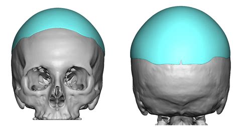 Blog Archivecase Study A Standard Preformed Skull Implant For