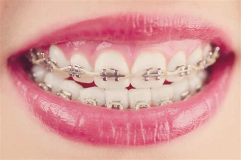 Are Power Chains The Last Step In Braces Power Chains Simply Explained