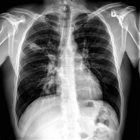 Pulmonary manifestations of cystic fibrosis are some of the best known in cystic fibrosis (cf). Distal intestinal obstruction syndrome (DIOS) in cystic ...
