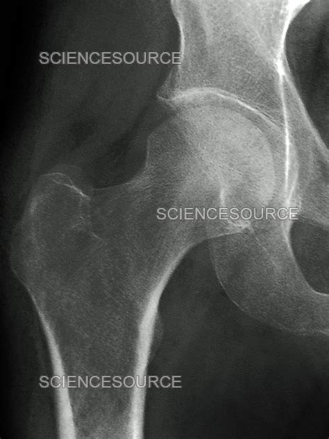 Normal Hip X Ray Stock Image Science Source Images