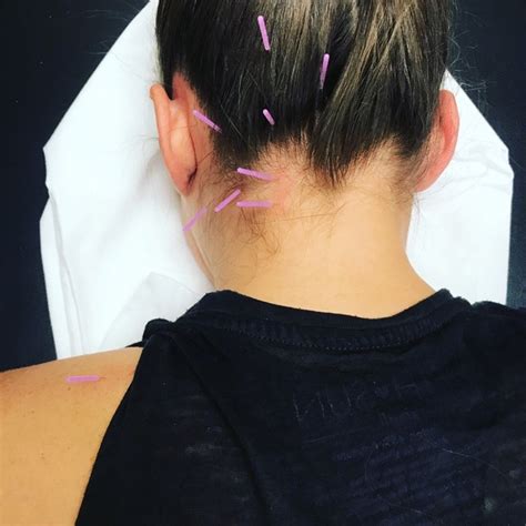 Can Dry Needling Help My Headaches Arizona Orthopedic Physical Therapy
