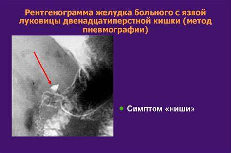 Язвенная болезнь желудка диета 1