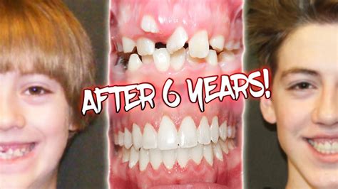 6 Years Of Braces Before And After Transformation Youtube