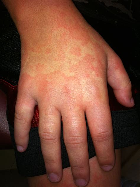 Mild Hives On Hands The Hippest Pics