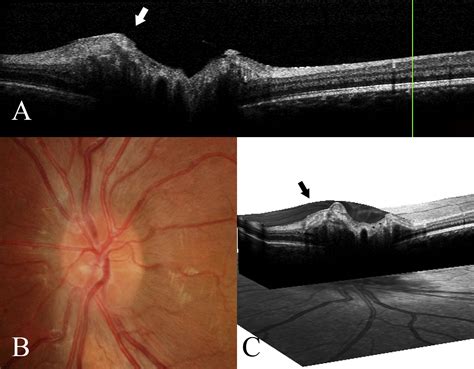 Differentiation Of Optic Nerve Head Drusen And Optic Disc Edema With